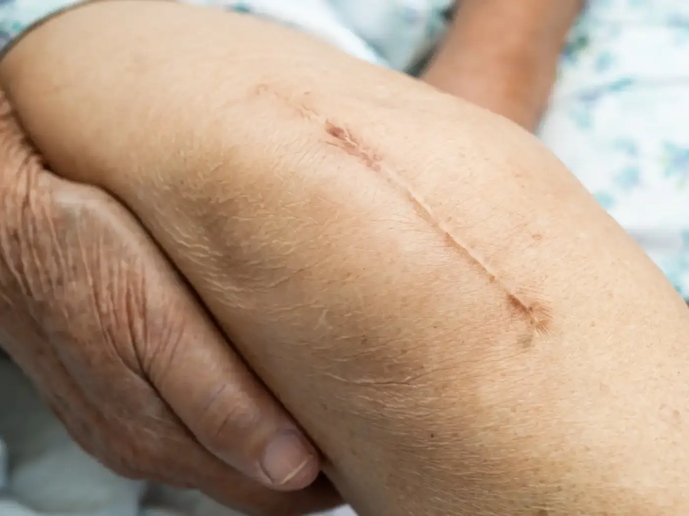 Person showing scar in knee