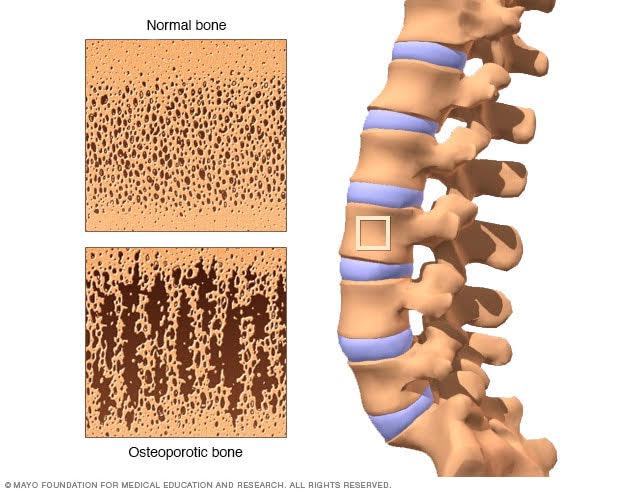 Image of normal bone and Osteoporosis bone